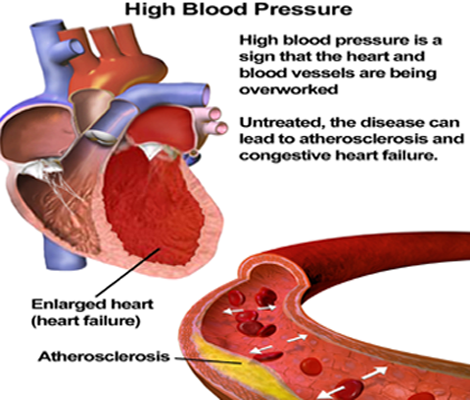 High Blood Pressure